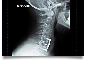 Oklahoma Spinal Cord Injury Attorneys